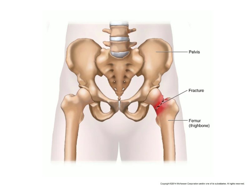 Osteopenia en cadera